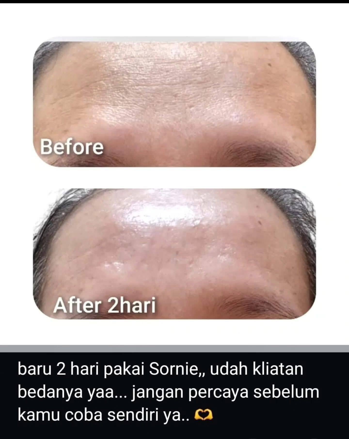 Testimoni Sornie Collagen Patch